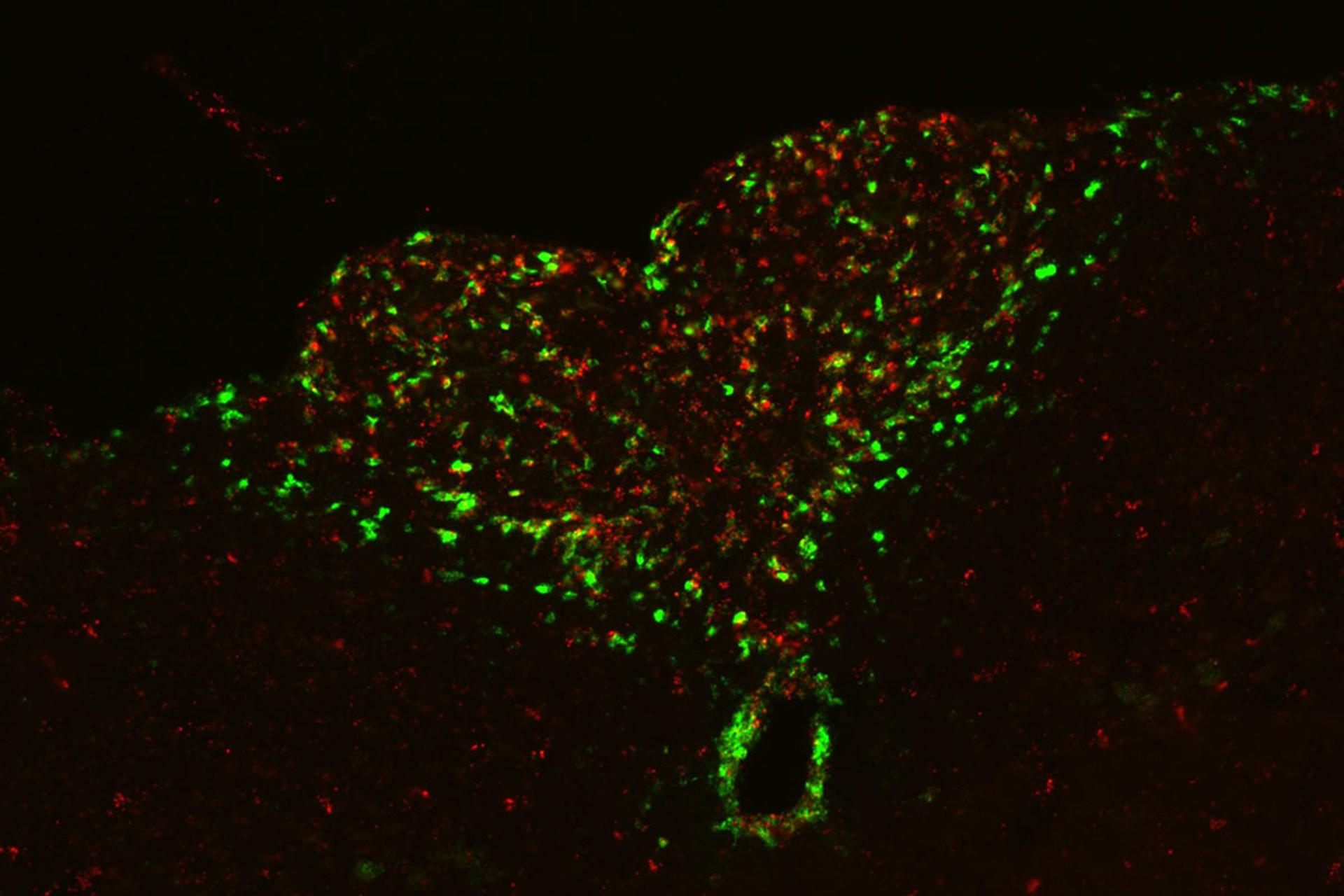 Investigadores identifican una conexión directa entre inflamación y la pérdida de motivación característica del cáncer avanzado. En un estudio con ratones, describieron una vía cerebral que comienza con neuronas (marcadas en verde, arriba) que detecta señales de inflamación. Imagen facilitada por la Universidad de Washington en St. Louise. EFE/ Aelita Zhu.