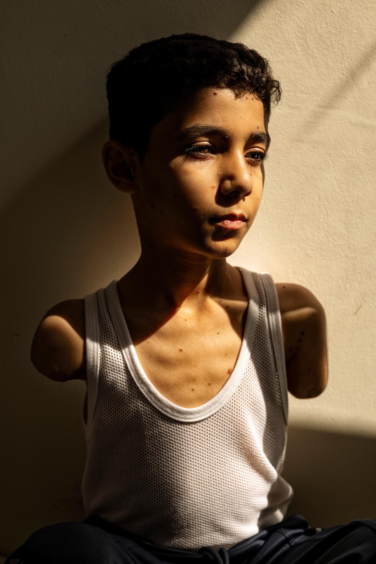 Foto facilitada por la Fundación World Press Photo que muestra la imagen ganadora del premio World Press Photo del Año 2025, realizada por Samar Abu Elouf para The New York Times, que muestra a Mahmoud Ajjour (9 años), herido durante un ataque israelí contra la ciudad de Gaza en marzo de 2024, encontrando refugio y atención médica en Catar. Doha, Catar, 28 de junio de 2024 (reeditada el 17 de abril de 2025). EFE/EPA/SAMAR ABU ELOUF / WORLD PRESS PHOTO FOUND / HANDOUT MANDATORY CREDIT: SAMAR ABU ELOUF FOR NEW YORK TIMES/WORLD PRESS PHOTO FOUNDATION -- NO COVERS -- NO CROPPING, RESIZING, MANIPULATING -- NO SOCIAL MEDIA USAGEHANDOUT EDITORIAL USE ONLY/NO SALES