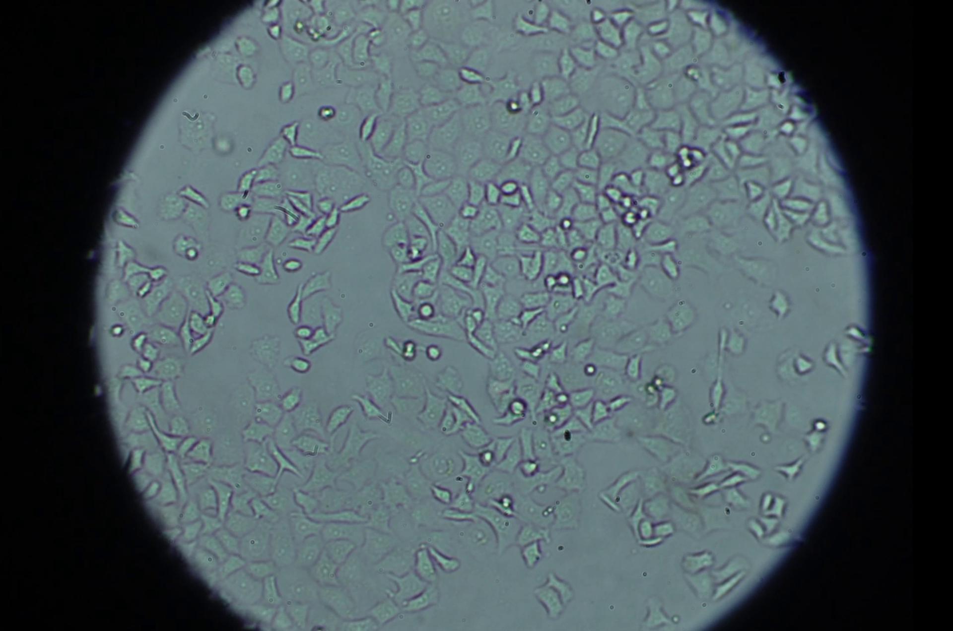 Una imagen al microscopio de las células tumorales de cáncer de páncreas. EFE/Crédito: Imagen cedida por el Hospital 12 de Octubre.