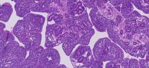 Histología característica de un tumor de Wilms en un recién nacido provocado por una mutación del gen FOXR2. Crédito: Ronald de Krijger / Centro Princesa Máxima de Oncología Pediátrica