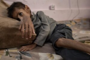 Más de 5.100 niños de entre seis meses y cinco años fueron admitidos para recibir tratamiento por desnutrición aguda solo en el mes de mayo en Gaza. EFE/EPA/HAITHAM IMAD