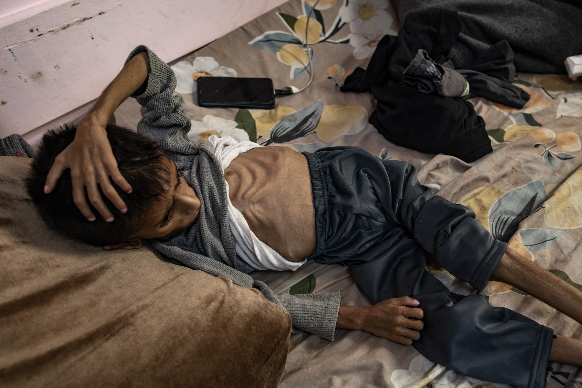 Un niño palestino de cinco años, que sufre de desnutrición severa, recibe tratamiento en el Hospital Al Nasser en Jan Yunis, en el sur de la Franja de Gaza, el 26 de mayo de 2025. EFE/EPA/HAITHAM IMAD