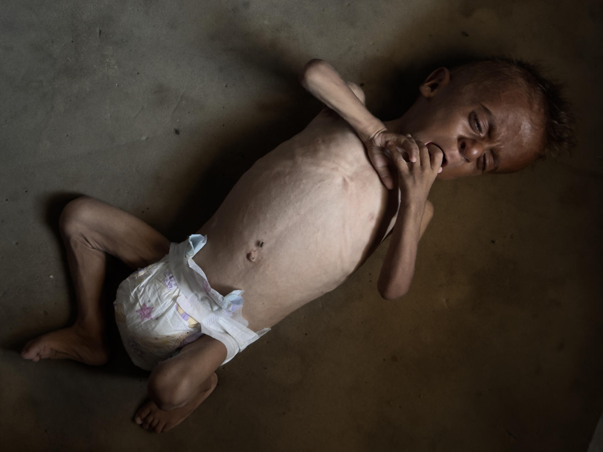 El pequeño gazatí Mohamed Motawaq, de tan solo 18 meses, de cuerpo esquelético pasa los días en Gaza en brazos de su madre, Hidaya, un mujer viuda, de 30 años, sin apenas leche y otros productos básicos por las restricciones que Israel. La desnutrición mató a otras cinco personas, incluido un bebe, en las últimas 24 horas en Gaza, informó el hospital Al Shifa de la franja palestina. EFE/ Ahmad Awad
