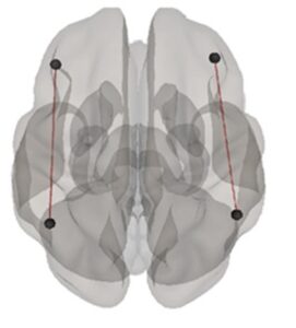 En la imagen se muestra un volumen en 3D de las cuatro áreas frontoparietales del cerebro que han recibido estimulación para mejorar el aprendizaje matemático. Crédito de la imagen: Zacharopoulos G y otros.