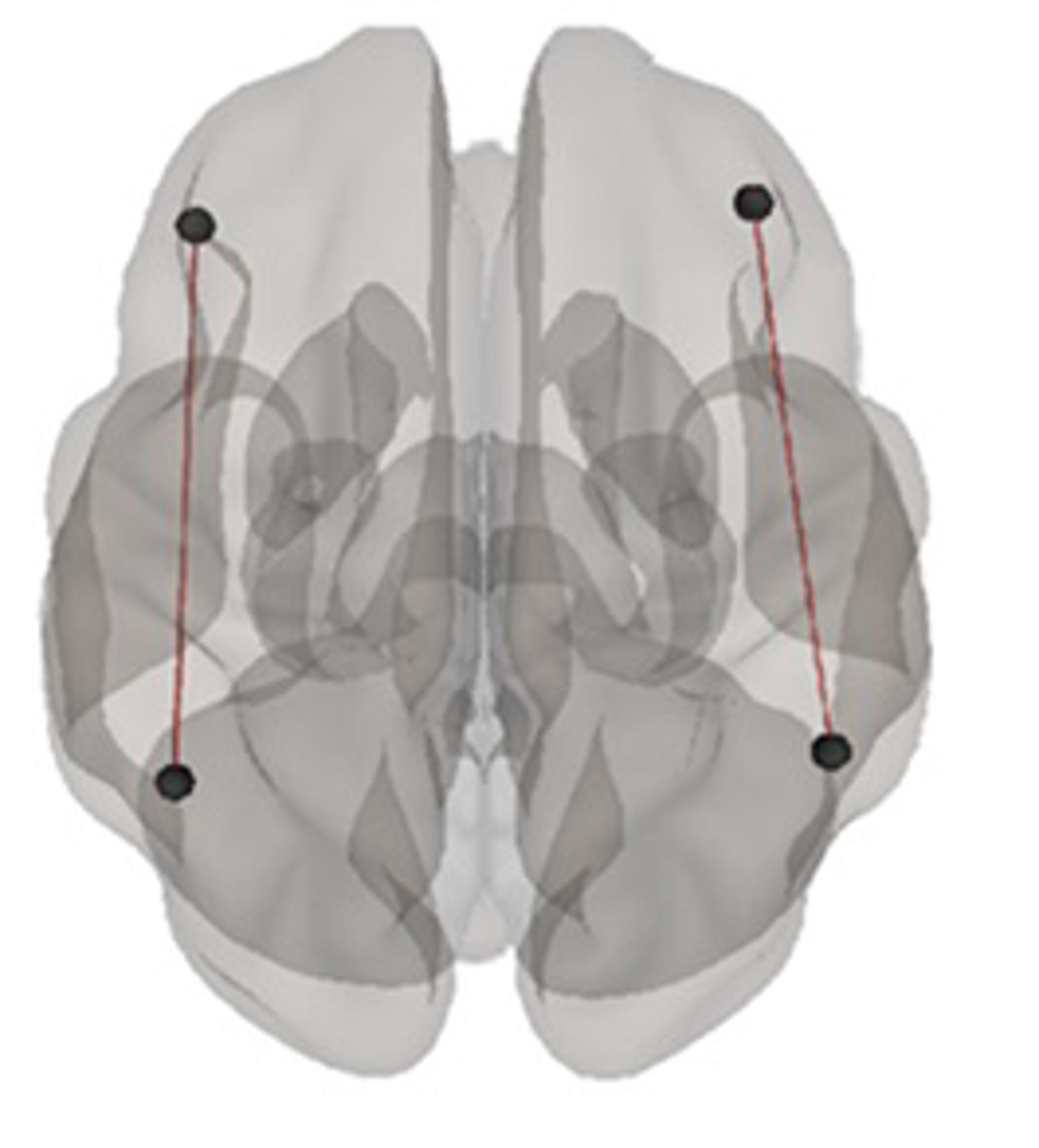En la imagen se muestra un volumen en 3D de las cuatro áreas frontoparietales del cerebro que han recibido estimulación para mejorar el aprendizaje matemático. Crédito de la imagen: Zacharopoulos G y otros.