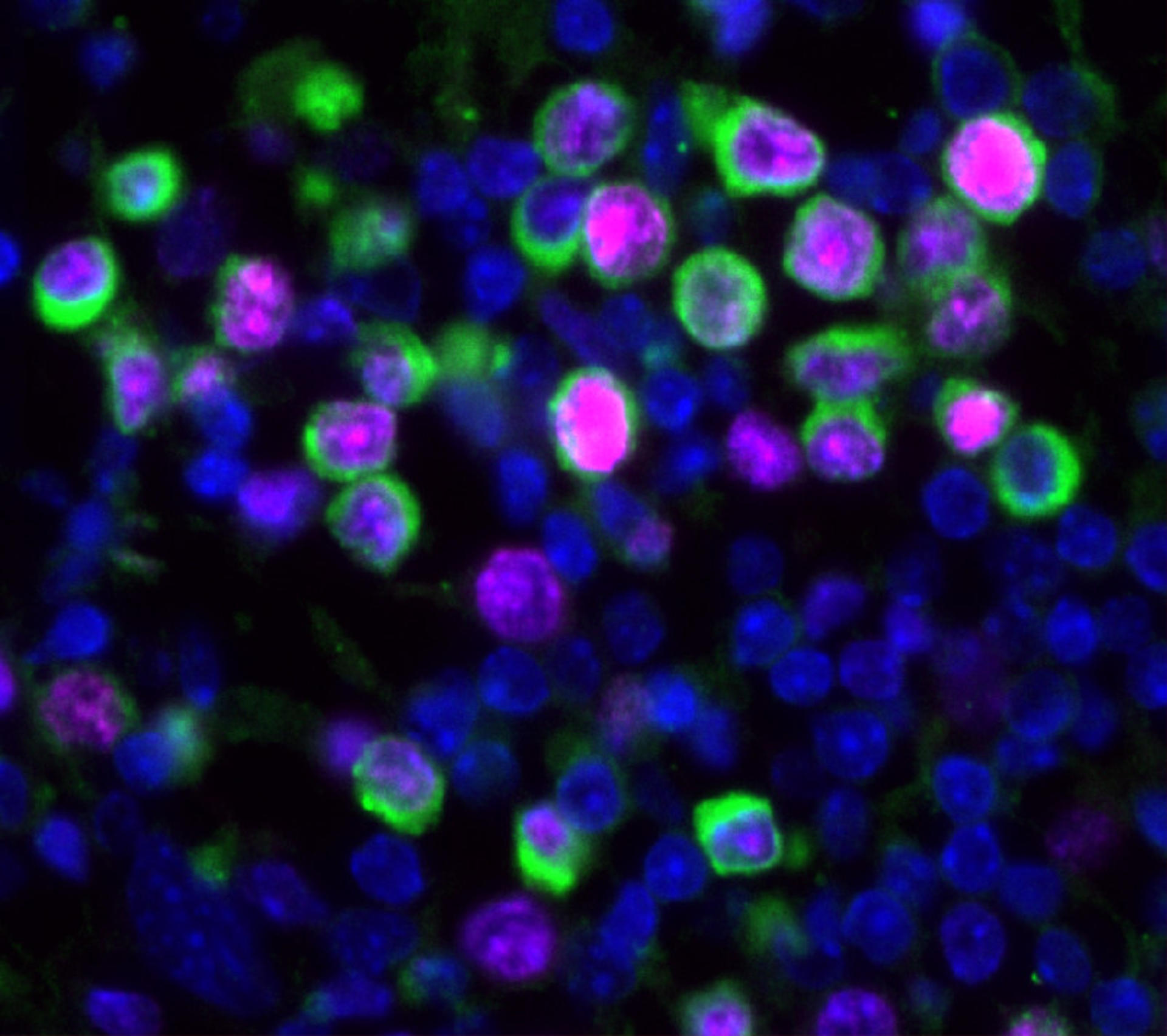 La infección por el virus de la gripe provoca la reactivación y expansión de células cancerosas latentes en los pulmones de ratones. Estas están marcadas en verde y el marcador de proliferación en magenta. Crédito: Bryan Johnson. Imagen facilitada por Nature.