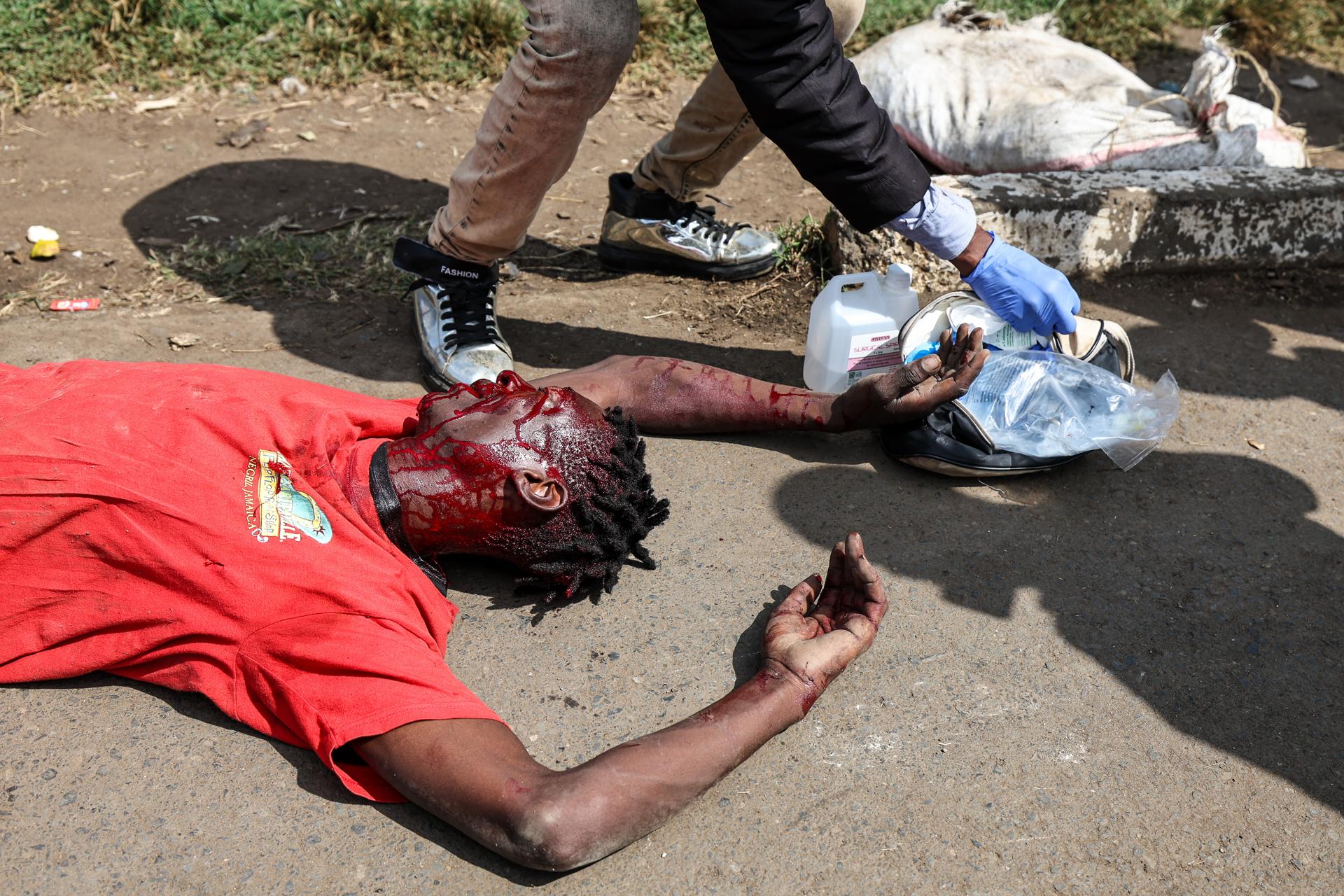 NAIROBI (Kenya), 07/07/2025.- An injured protester seeks medical help from a volunteer firstaider after being shot with a rubber bullet by anti-riot police during anti-government protest on Saba Saba day (or Seven-Seven in Swahili language) in Nairobi, Kenya, 07 July 2025. Nairobi’s Central Business District remained on a lockdown as most business owners hired counter-protesters armed with clubs to protect their business from looters as police used tear gas and rubber bullets to disperse hundreds of protestors in the outskirts of Nairobi during the protest. The Saba Saba Day commemorates protests and government crackdown on a multi-party democracy movement in Kenya in the 1990s. (Protestas, Kenia) EFE/EPA/DANIEL IRUNGU