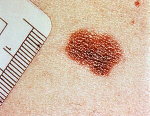 En el ensayo participaron doce pacientes con diversos tipos de cáncer metastásico: melanoma (en la imagen), carcinoma de células renales y diferentes tipos de cáncer de mama. EFE/ [ARCHIVO]