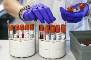 La hepatitis A sigue escalando en España y, en lo que va de 2025, se han diagnosticado un total de 1.014 casos, casi el doble que en el mismo periodo del año anterior y un 11 % más que los diagnosticados en todo 2024, según los últimos datos del Instituto de Salud Carlos III (ISCIII). EFE/Javier Cebollada