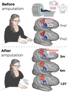 Ilustración de los mapas de actividad cerebral para la mano (mostrados en rojo) y los labios (azul) antes de la amputación y 3, 6 y 18 meses después de la amputación. Crédito: Tamar Makin/Hunter Schone/Universidad de Cambridge/SOLO USO EDITORIAL