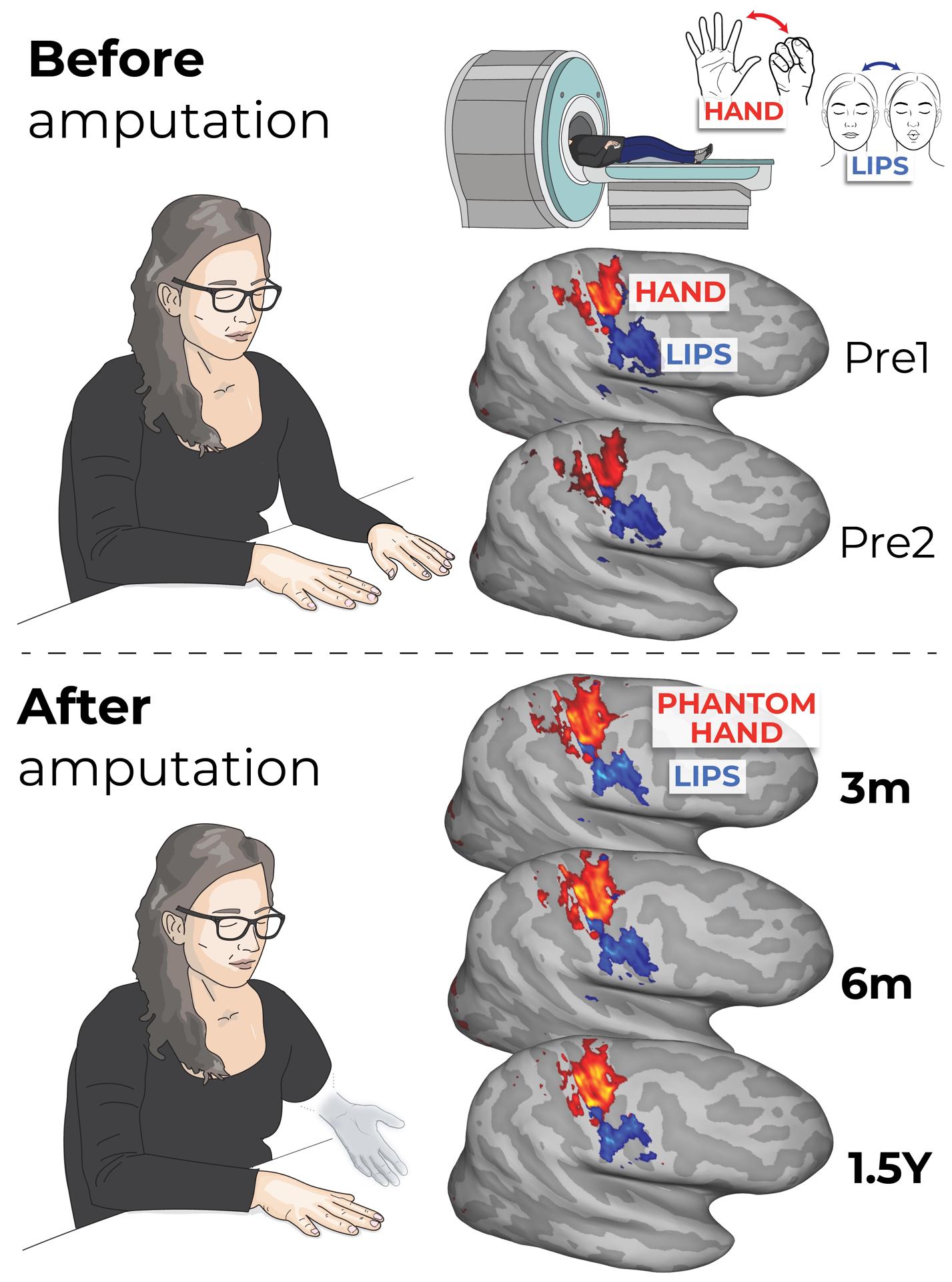 Ilustración de los mapas de actividad cerebral para la mano (mostrados en rojo) y los labios (azul) antes de la amputación y 3, 6 y 18 meses después de la amputación. Crédito: Tamar Makin/Hunter Schone/Universidad de Cambridge/SOLO USO EDITORIAL