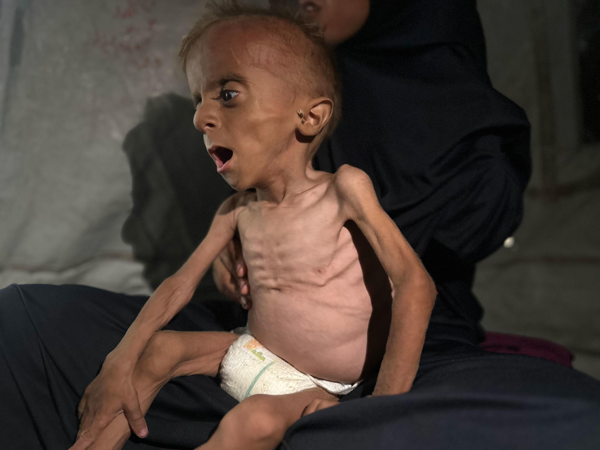 Imagen del 6 de agosto del 2025 del pequeño Mohamed Motawaq con la tripa hinchada y los brazos esqueléticos.EFE/ Ahmad Awad
