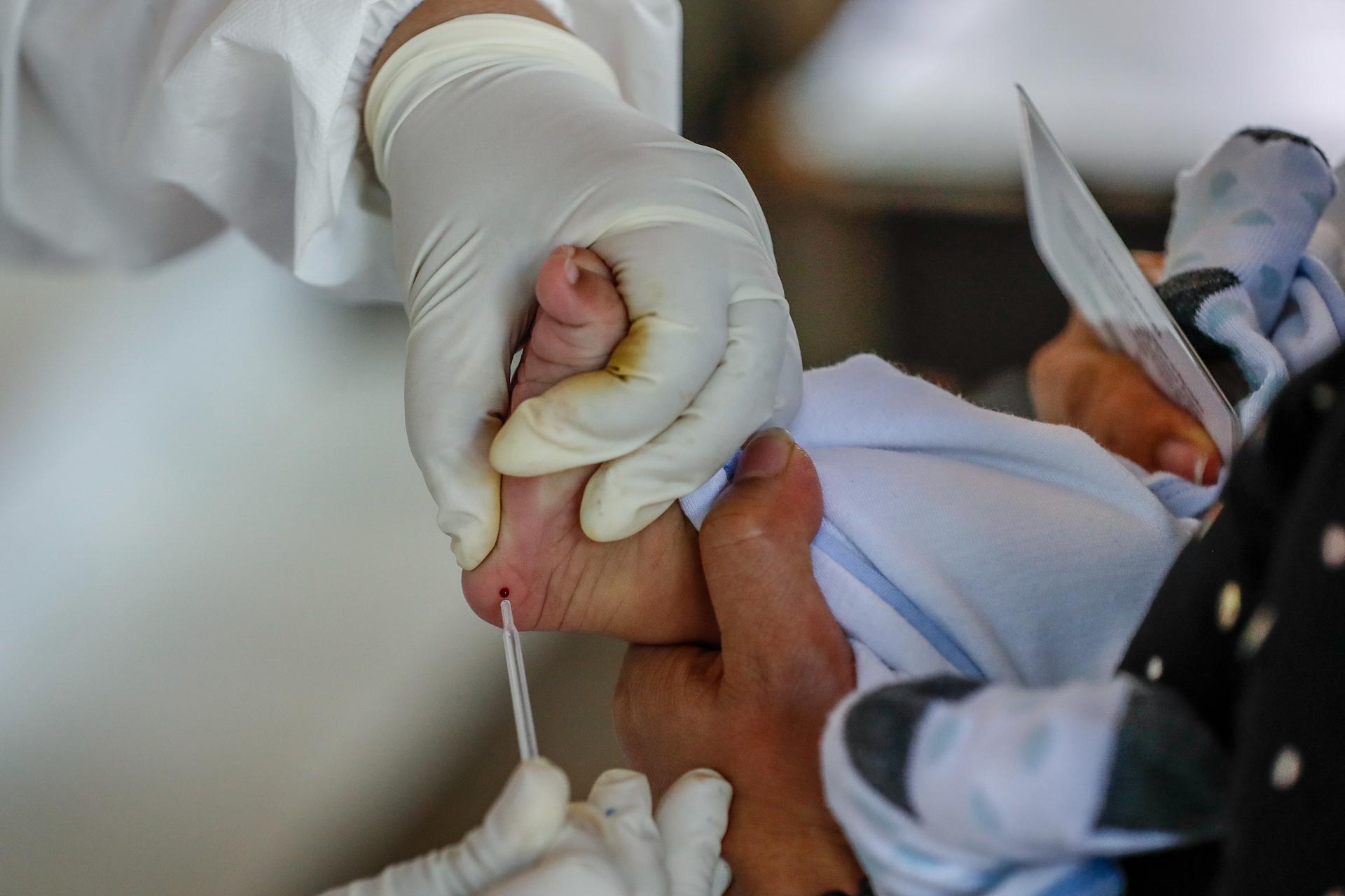 Imagen de archivo de la prueba de atrofia muscular espinal (AME) en un bebé. EFE/EPA/MARK R. CRISTINO