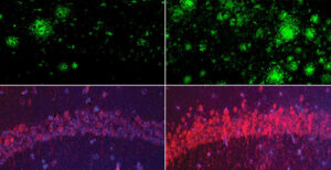 Fila superior de la imagen: en un modelo de ratón de alzhéimer, la deficiencia de litio (derecha) aumentó drásticamente los depósitos de beta amiloide en el cerebro, en comparación con ratones con niveles fisiológicos normales de litio (izquierda). Fila inferior: lo mismo ocurrió con la proteína tau, responsable de los ovillos neurofibrilares. Crédito: Yankner Lab. Foto facilitada por la Facultad de Medicina de Harvard.
