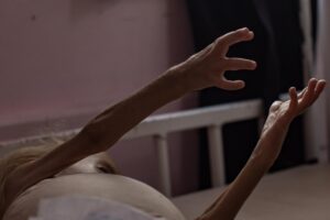 Sham Qudeih, un niño palestino de dos años, yace desnutrido en una cama en el Hospital Nasser, en Jan Yunis, en el sur de la Franja de Gaza, el 10 de agosto de 2025. EFE/HAITHAM IMAD