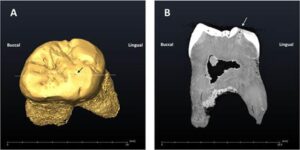 Reconstrucción virtual del diente del Neandertal de El Sidrón con la caries, indicada con una flecha. Imagen: Museo Nacional de Ciencias Naturales (MNCN-CSIC)