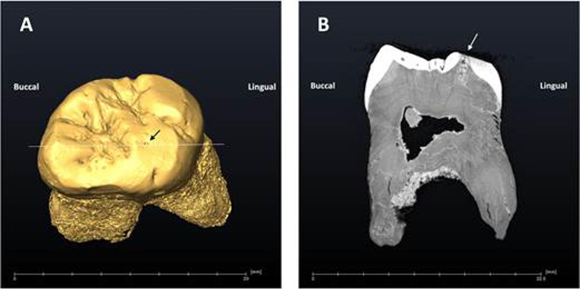 Reconstrucción virtual del diente del Neandertal de El Sidrón con la caries, indicada con una flecha. Imagen: Museo Nacional de Ciencias Naturales (MNCN-CSIC)