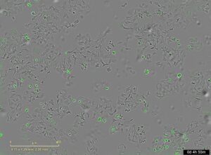 Un estudio internacional liderado por el Centro de Investigación del Cáncer (CIC) ha identificado un mecanismo por el cual una proteína secretada por la bacteria 'vibrio cholerae' es capaz de destruir células cancerosas. La imagen representa las células de cáncer muertas al activarse esa proteína. Imagen cedida por el CIC.